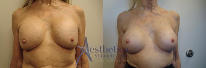 Breast Augmentation Revision Case 701 Before & After Front | Columbus, OH | Aesthetica Surgery & Spa