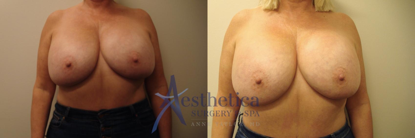 Breast Augmentation Revision Case 703 Before & After Front | Columbus, OH | Aesthetica Surgery & Spa