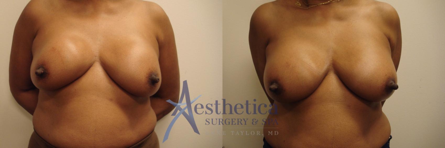 Breast Augmentation Revision Case 706 Before & After Front | Columbus, OH | Aesthetica Surgery & Spa