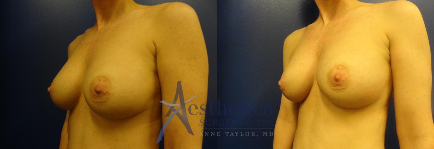 Breast Augmentation Revision Case 72 Before & After View #1 | Columbus, OH | Aesthetica Surgery & Spa