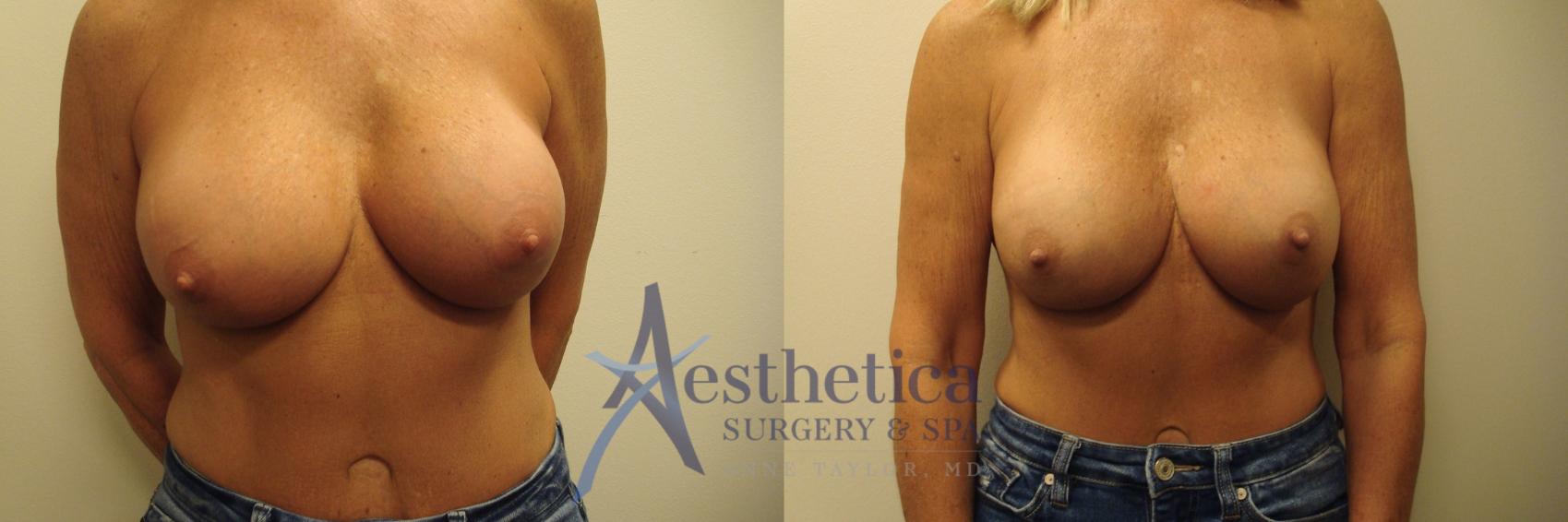 Breast Augmentation Revision Case 721 Before & After Front | Columbus, OH | Aesthetica Surgery & Spa