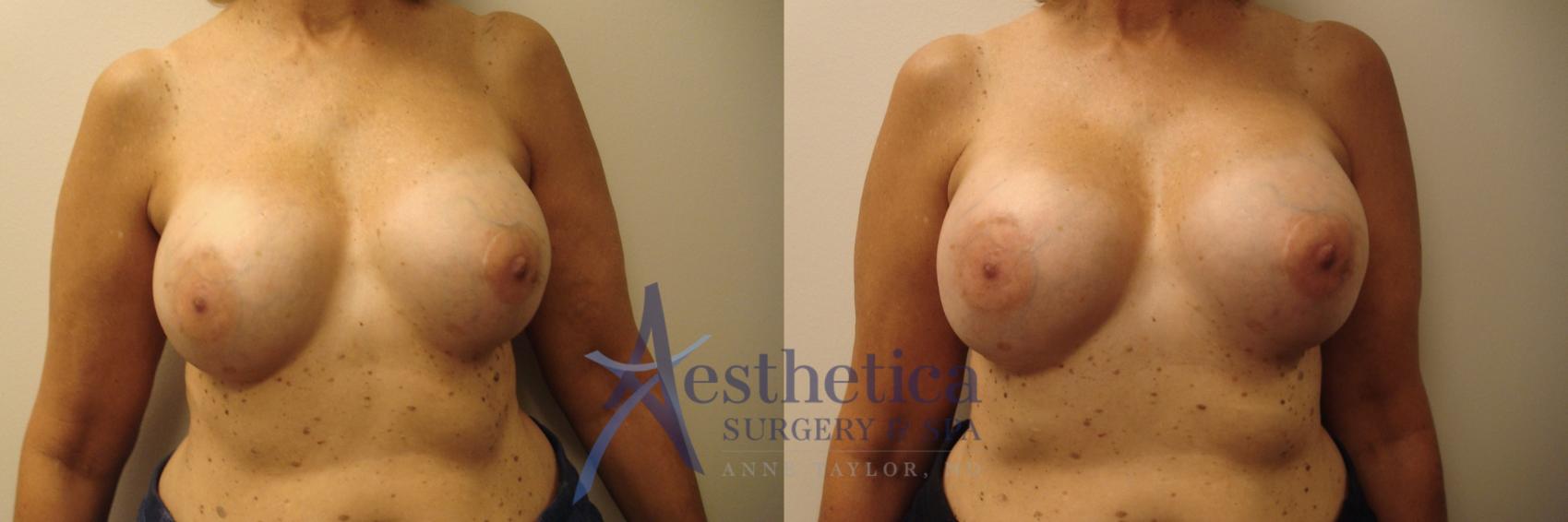 Breast Augmentation Revision Case 733 Before & After Front | Columbus, OH | Aesthetica Surgery & Spa