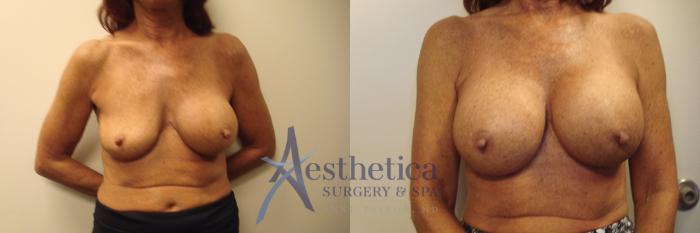 Breast Augmentation Revision Case 741 Before & After Front | Columbus, OH | Aesthetica Surgery & Spa