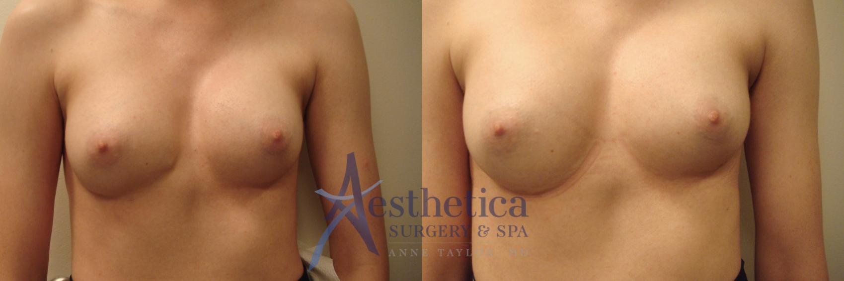 Breast Augmentation Revision Case 744 Before & After Front | Columbus, OH | Aesthetica Surgery & Spa