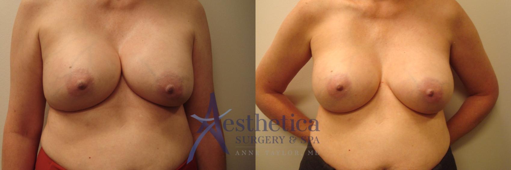 Breast Augmentation Revision Case 745 Before & After Front | Columbus, OH | Aesthetica Surgery & Spa