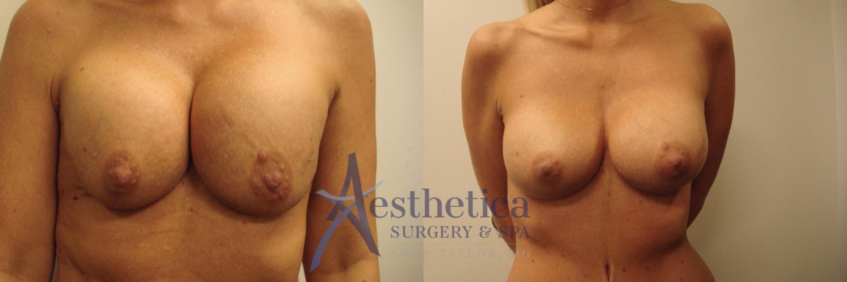 Breast Augmentation Revision Case 748 Before & After Front | Columbus, OH | Aesthetica Surgery & Spa