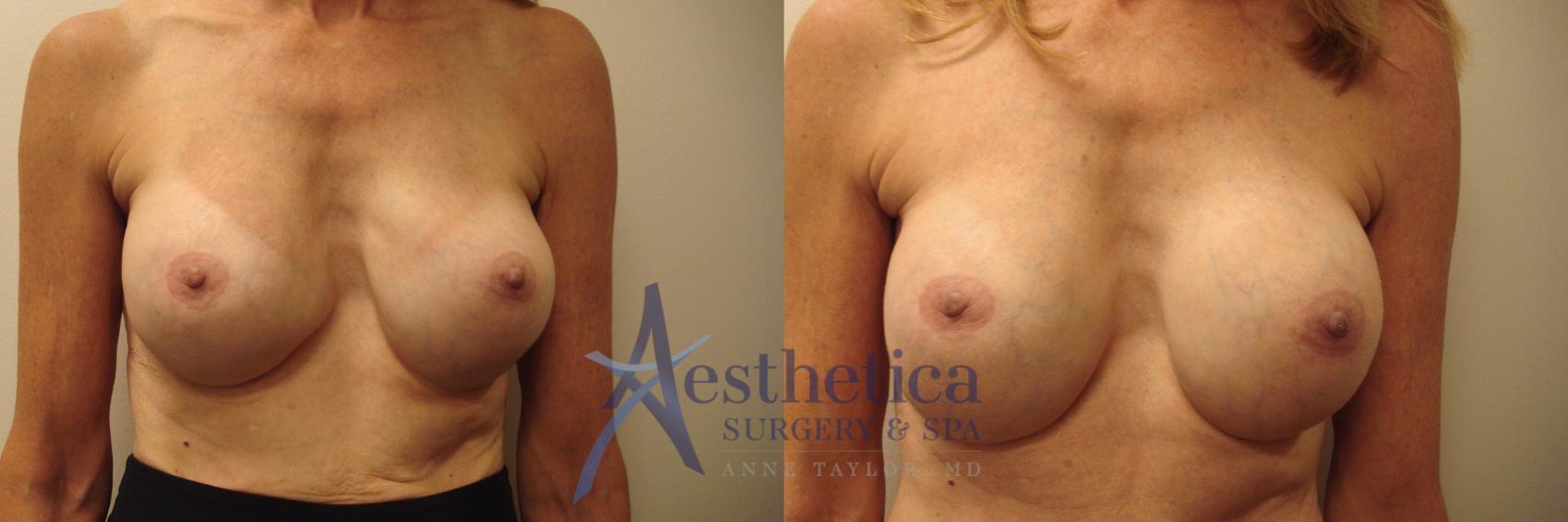 Breast Augmentation Revision Case 758 Before & After Front | Columbus, OH | Aesthetica Surgery & Spa