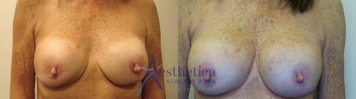 Breast Augmentation Revision Case 763 Before & After Front | Columbus, OH | Aesthetica Surgery & Spa