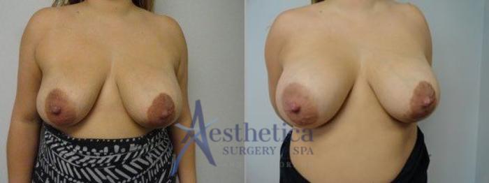 Breast Augmentation Revision Case 8 Before & After View #1 | Columbus, OH | Aesthetica Surgery & Spa