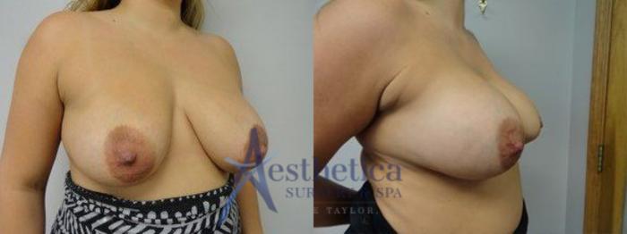 Breast Augmentation Revision Case 8 Before & After View #2 | Columbus, OH | Aesthetica Surgery & Spa