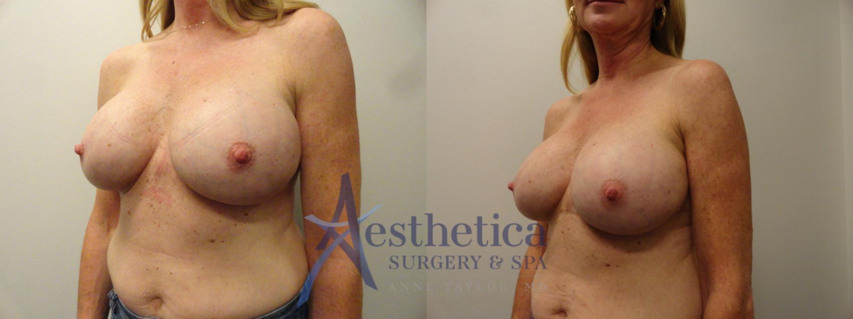 Breast Augmentation Revision Case 832 Before & After Left Oblique | Columbus, OH | Aesthetica Surgery & Spa