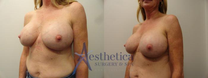 Breast Augmentation Revision Case 832 Before & After Left Oblique | Columbus, OH | Aesthetica Surgery & Spa