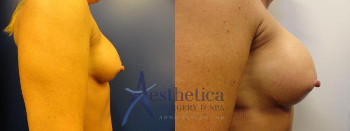 Breast Augmentation Revision Case 84 Before & After View #1 | Columbus, OH | Aesthetica Surgery & Spa