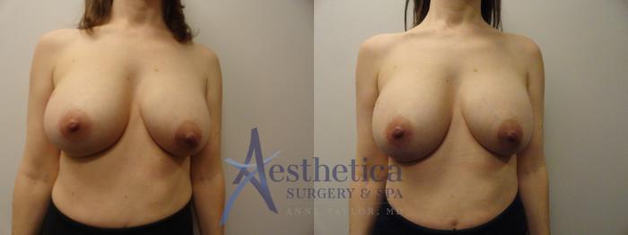 Breast Augmentation Revision Case 840 Before & After Front | Columbus, OH | Aesthetica Surgery & Spa