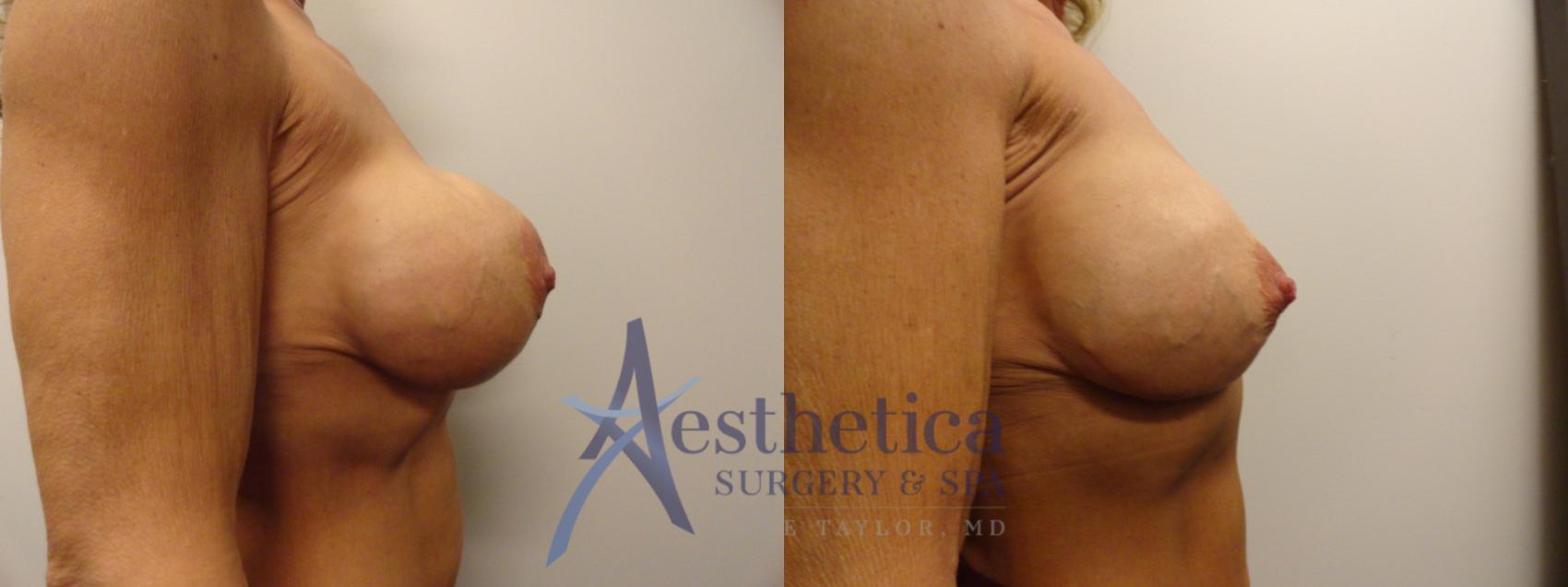 Breast Augmentation Revision Case 867 Before & After Back | Columbus, OH | Aesthetica Surgery & Spa