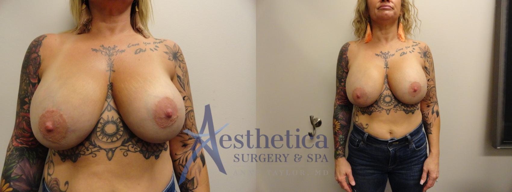 Breast Augmentation Revision Case 868 Before & After Front | Columbus, OH | Aesthetica Surgery & Spa