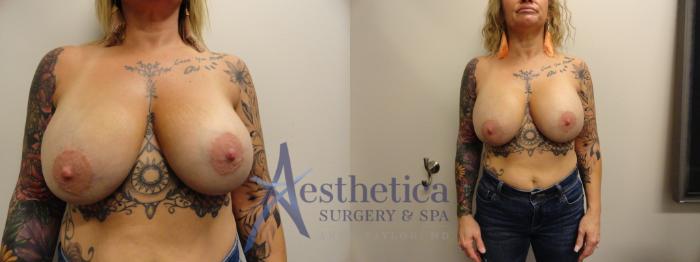 Breast Augmentation Revision Case 868 Before & After Front | Columbus, OH | Aesthetica Surgery & Spa