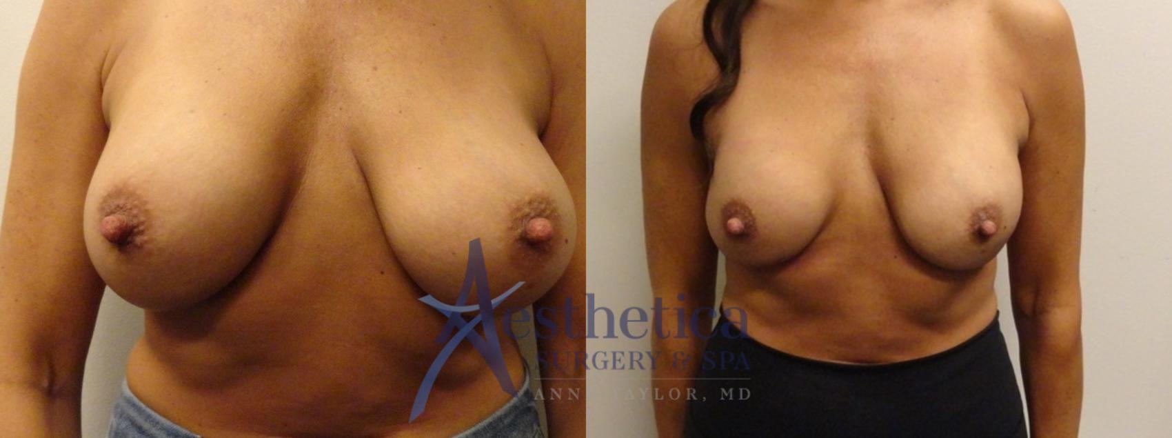 Breast Augmentation Revision Case 871 Before & After Front | Columbus, OH | Aesthetica Surgery & Spa