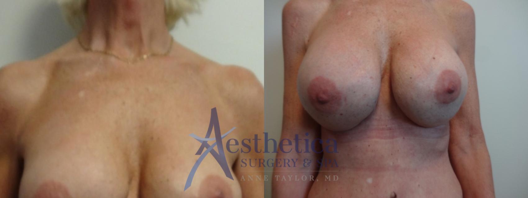 Breast Augmentation Revision Case 884 Before & After Front | Columbus, OH | Aesthetica Surgery & Spa
