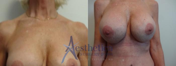 Breast Augmentation Revision Case 884 Before & After Front | Columbus, OH | Aesthetica Surgery & Spa