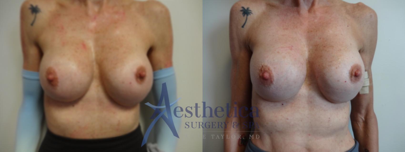 Breast Augmentation Revision Case 894 Before & After Front | Columbus, OH | Aesthetica Surgery & Spa