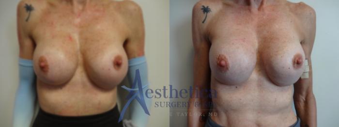 Breast Augmentation Revision Case 894 Before & After Front | Columbus, OH | Aesthetica Surgery & Spa