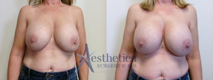 Breast Augmentation Revision Case 909 Before & After Front | Columbus, OH | Aesthetica Surgery & Spa