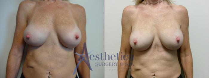Breast Augmentation Revision Case 910 Before & After Front | Columbus, OH | Aesthetica Surgery & Spa