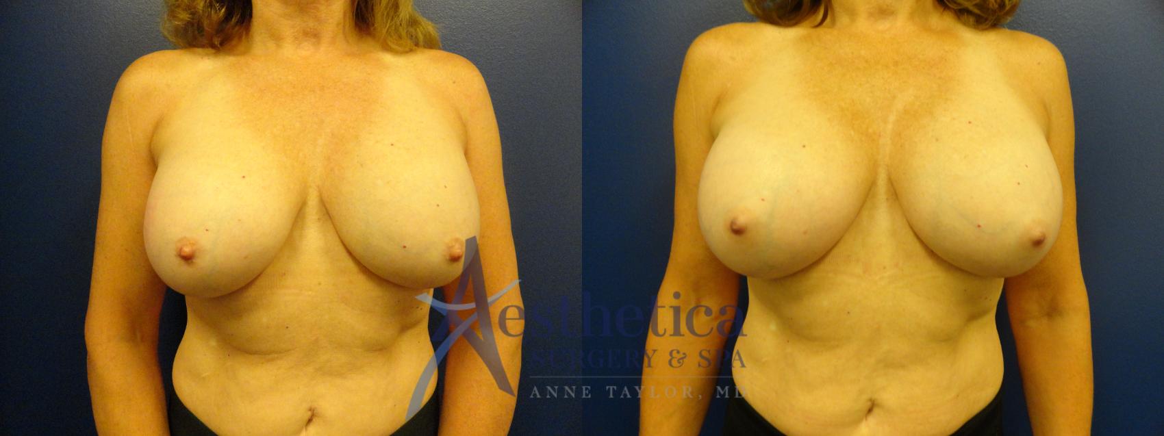 Breast Augmentation Revision Case 92 Before & After View #1 | Columbus, OH | Aesthetica Surgery & Spa