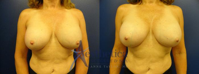 Breast Augmentation Revision Case 92 Before & After View #1 | Columbus, OH | Aesthetica Surgery & Spa