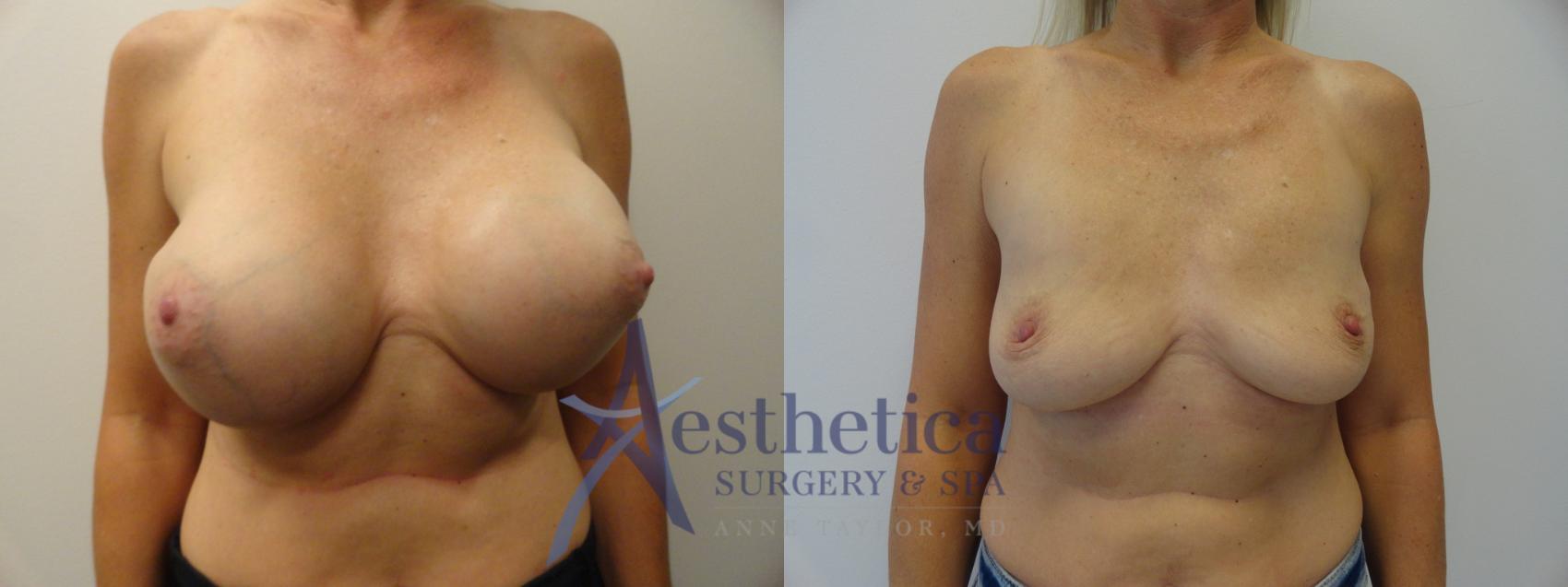 Breast Implant Removal  Case 274 Before & After View #1 | Columbus, OH | Aesthetica Surgery & Spa