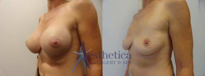 Breast Implant Removal  Case 274 Before & After View #2 | Columbus, OH | Aesthetica Surgery & Spa