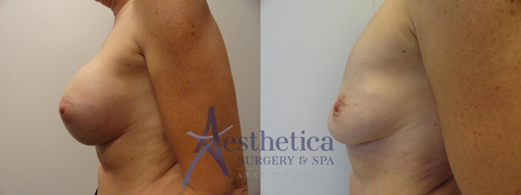Breast Implant Removal  Case 274 Before & After View #3 | Columbus, OH | Aesthetica Surgery & Spa