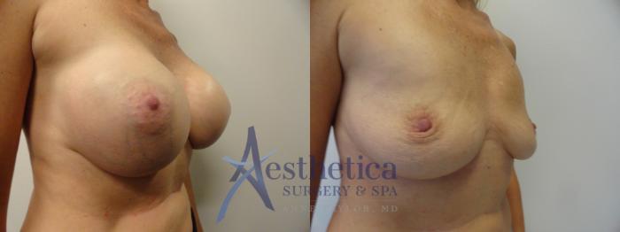 Breast Implant Removal  Case 274 Before & After View #4 | Columbus, OH | Aesthetica Surgery & Spa