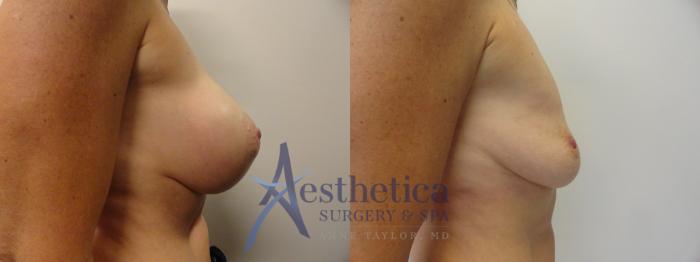 Breast Implant Removal  Case 274 Before & After View #5 | Columbus, OH | Aesthetica Surgery & Spa