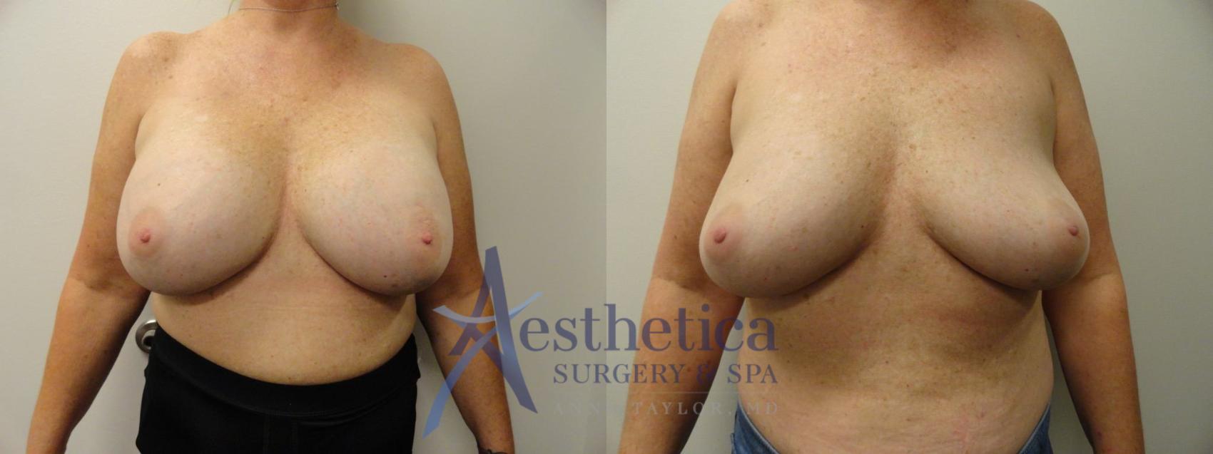 Breast Implant Removal  Case 283 Before & After View #1 | Columbus, OH | Aesthetica Surgery & Spa