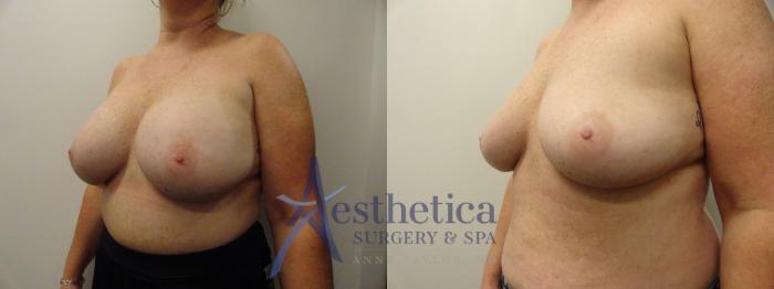 Breast Implant Removal  Case 283 Before & After View #2 | Columbus, OH | Aesthetica Surgery & Spa