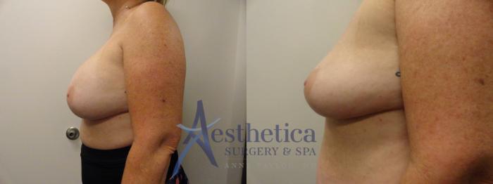 Breast Implant Removal  Case 283 Before & After View #3 | Columbus, OH | Aesthetica Surgery & Spa