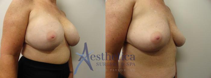 Breast Implant Removal  Case 283 Before & After View #4 | Columbus, OH | Aesthetica Surgery & Spa
