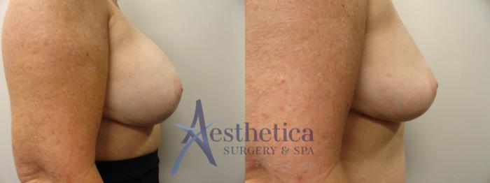 Breast Implant Removal  Case 283 Before & After View #5 | Columbus, OH | Aesthetica Surgery & Spa