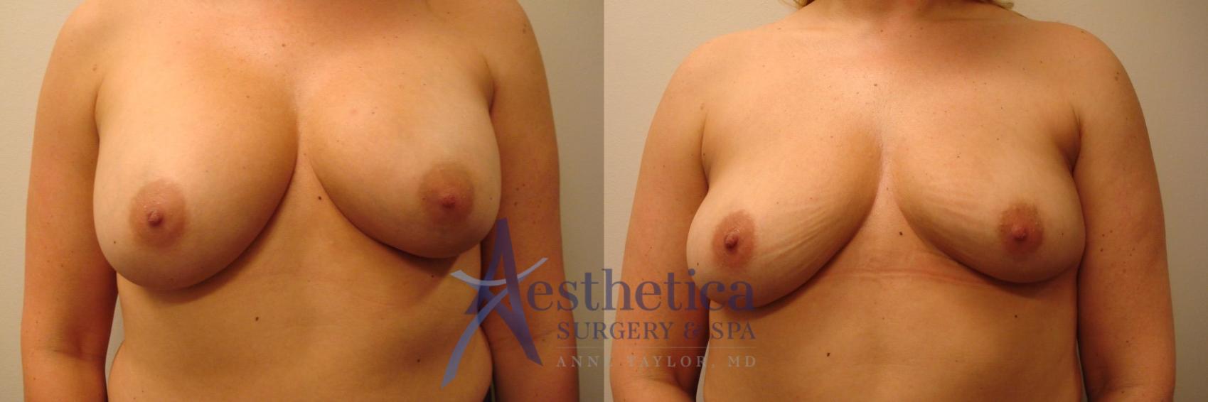 Breast Implant Removal  Case 315 Before & After View #1 | Columbus, OH | Aesthetica Surgery & Spa