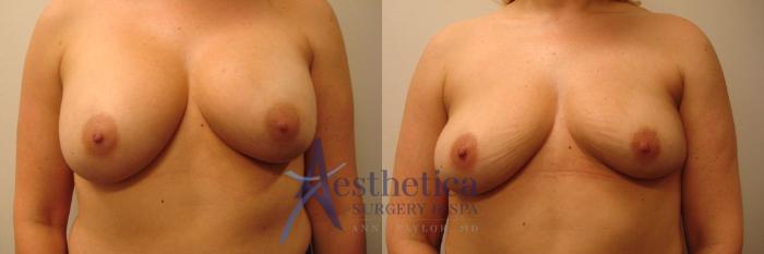 Breast Implant Removal  Case 315 Before & After View #1 | Columbus, OH | Aesthetica Surgery & Spa