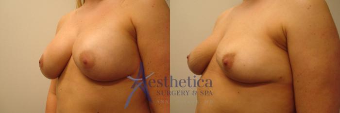 Breast Implant Removal  Case 315 Before & After View #2 | Columbus, OH | Aesthetica Surgery & Spa