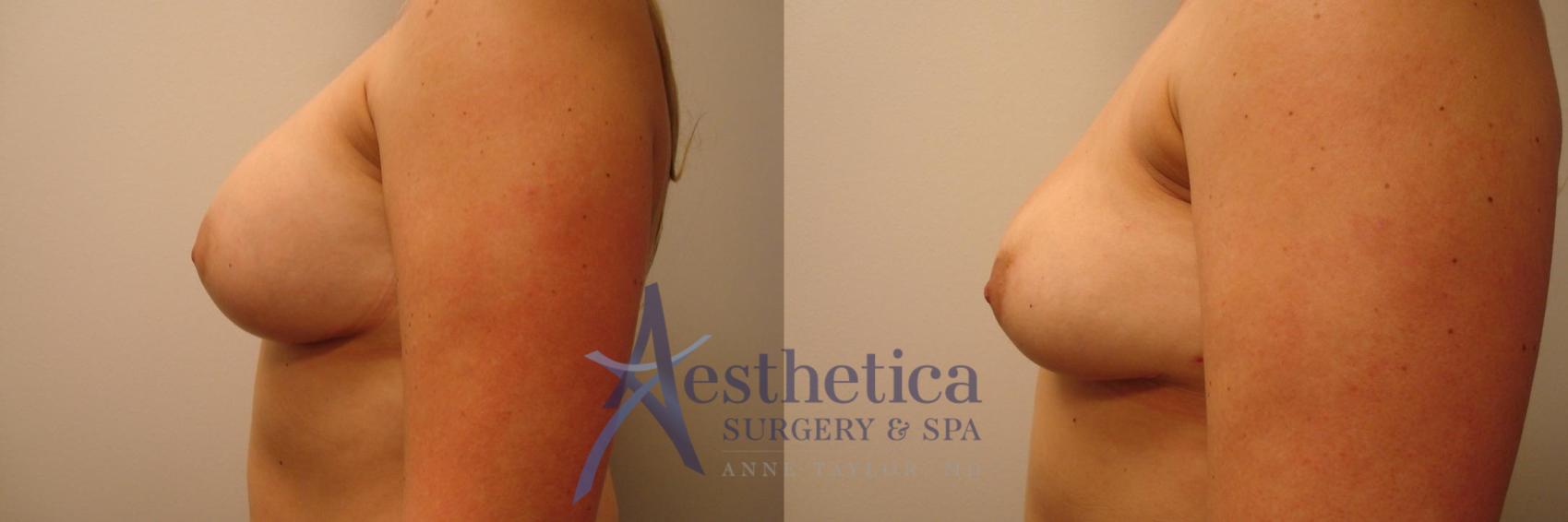 Breast Implant Removal  Case 315 Before & After View #3 | Columbus, OH | Aesthetica Surgery & Spa