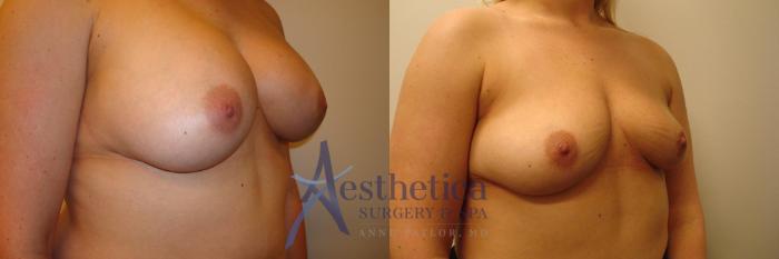 Breast Implant Removal  Case 315 Before & After View #4 | Columbus, OH | Aesthetica Surgery & Spa