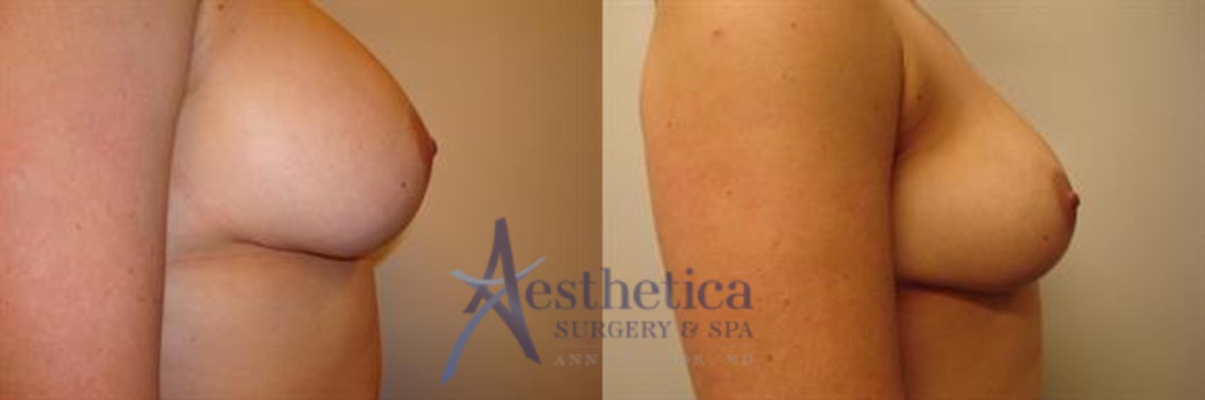 Breast Implant Removal  Case 315 Before & After View #5 | Columbus, OH | Aesthetica Surgery & Spa