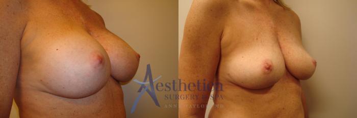 Breast Implant Removal  Case 316 Before & After View #2 | Columbus, OH | Aesthetica Surgery & Spa