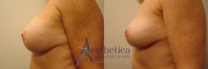 Breast Implant Removal  Case 316 Before & After View #3 | Columbus, OH | Aesthetica Surgery & Spa