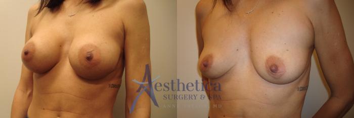 Breast Implant Removal  Case 521 Before & After Left Oblique | Columbus, OH | Aesthetica Surgery & Spa