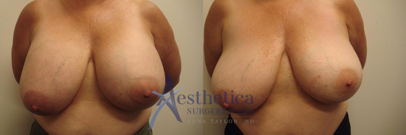 Breast Implant Removal  Case 523 Before & After Front | Worthington, OH | Aesthetica Surgery & Spa